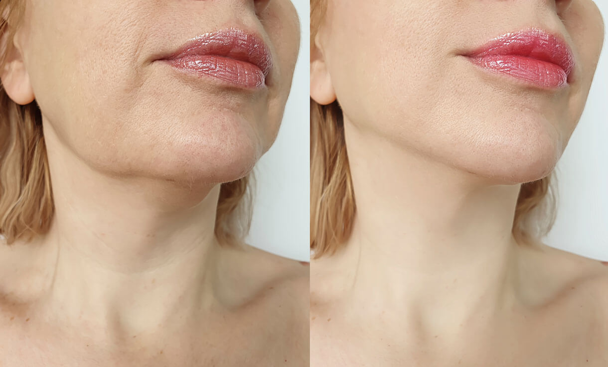 woman with dermal fillers before and after