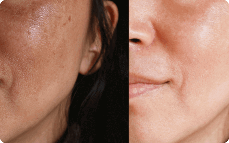 Before and after Mixto CO2 Laser Resurfacing