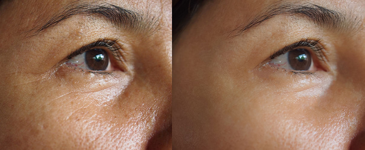 close up of eye before and after botox