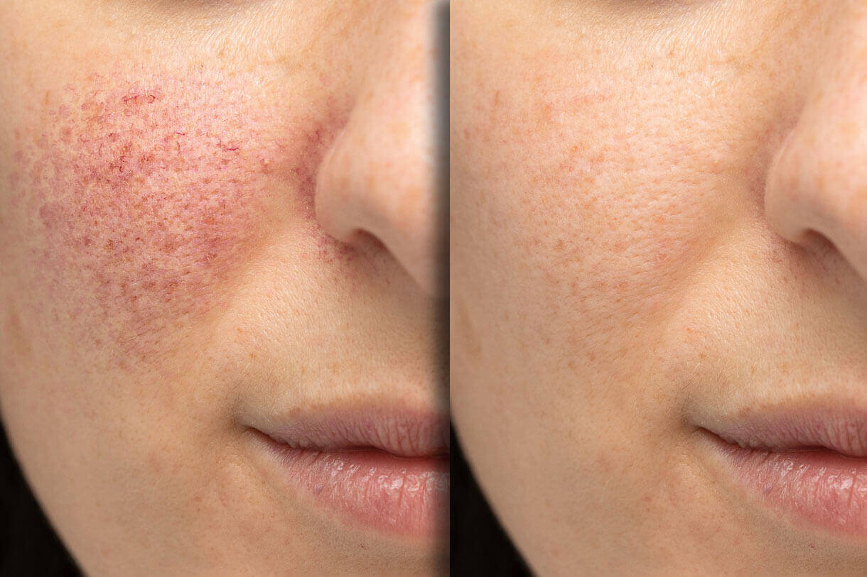 rosacea on patient's face before and after treatment