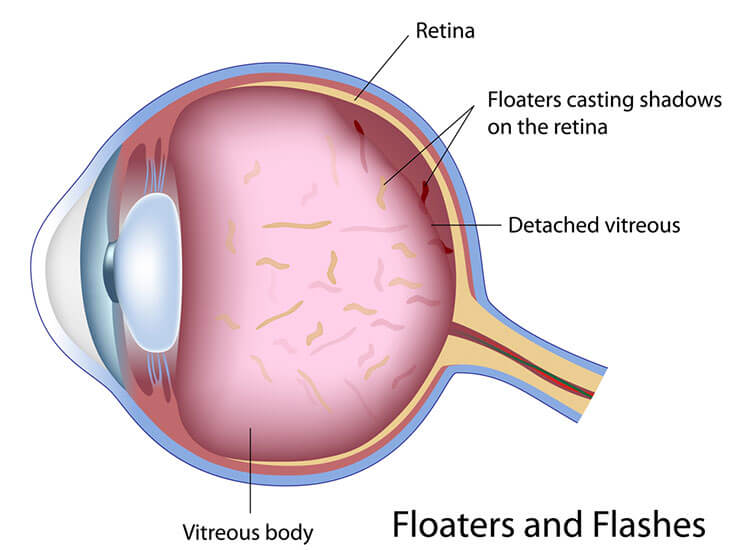 Floaters and flashes graphic illustration