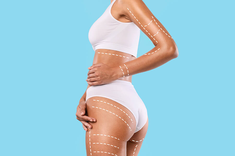 woman's body after the lumenis nuera tight treatment